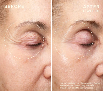 Volume Recovery Set